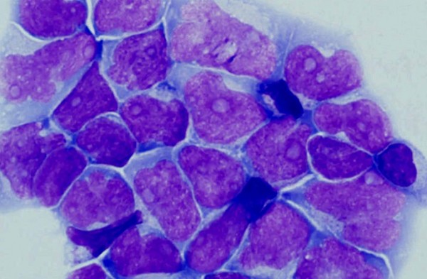 Researchers discover key protein in turning cancer aggressive Researchers discover key protein in turning cancer aggressive